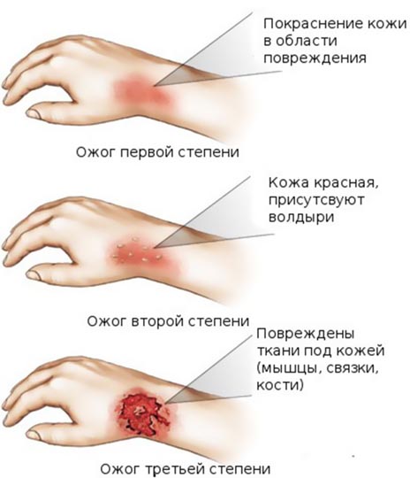 Что поможет от ожогов кипятком в домашних условиях снять боль